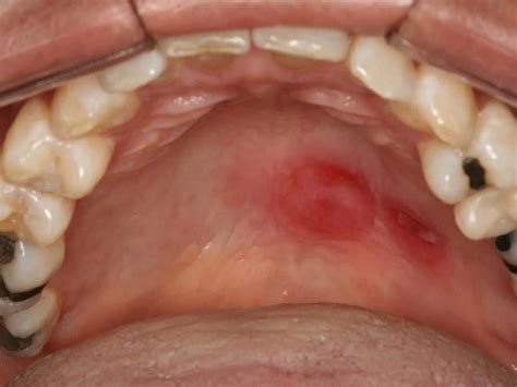 sífilis na boca sintomas